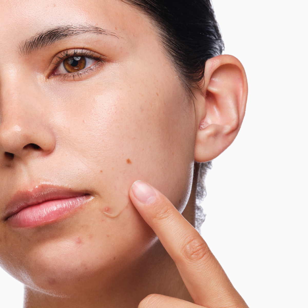the-acne-set-l4 rdn-the-acne-set-application.png