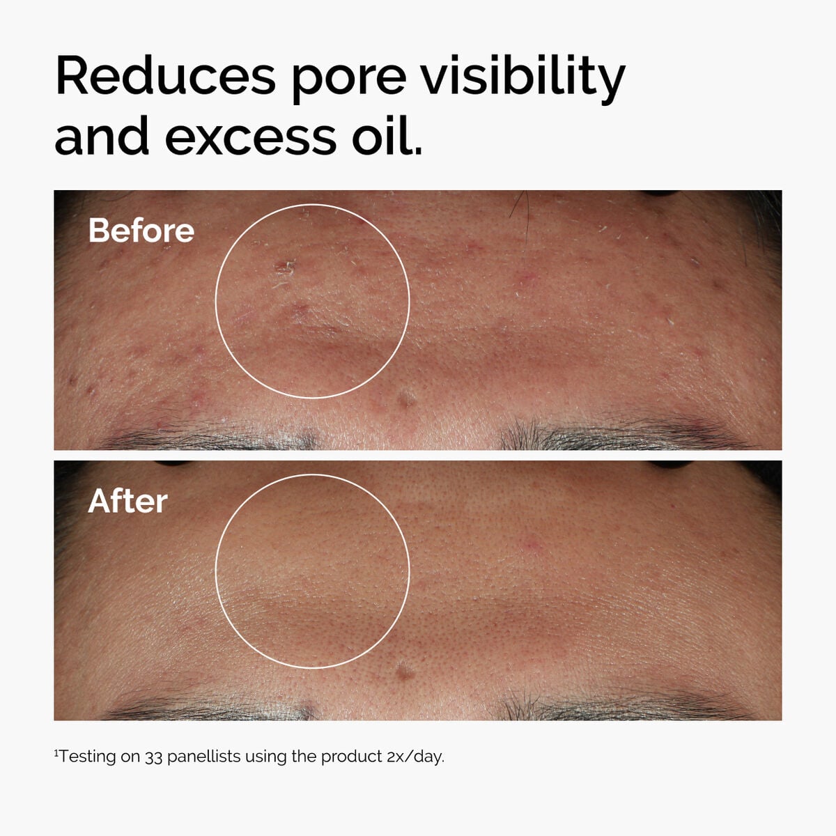 niacinamide-10-zinc-1-o7 ord-niacinamide-zinc-blemish-serum-before-after-pores.jpg